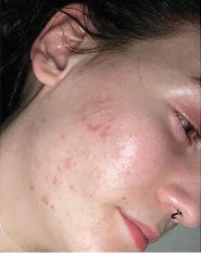 Điều trị da mụn – trước